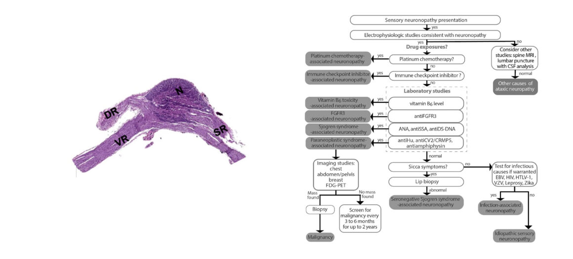 A Rare Case of Sensory Ganglionopathy: Exploring Gait Disturbance and Sudden Hearing Loss in a Young Female