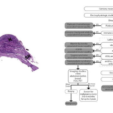 A Rare Case of Sensory Ganglionopathy: Exploring Gait Disturbance and Sudden Hearing Loss in a Young Female